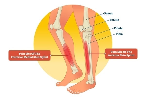 シンスプリント